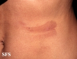 phytophotodermatitis