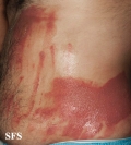 phytophotodermatitis
