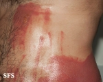 phytophotodermatitis