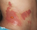 phytophotodermatitis