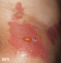 phytophotodermatitis