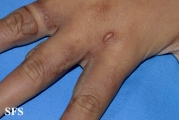 phytophotodermatitis