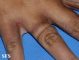 phytophotodermatitis