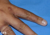 phytophotodermatitis