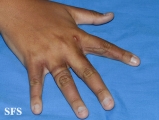 phytophotodermatitis