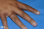 phytophotodermatitis