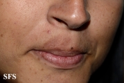 phytophotodermatitis