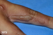 phytophotodermatitis