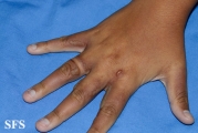 phytophotodermatitis