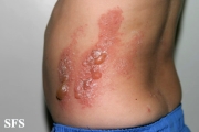 phytophotodermatitis