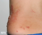 phytophotodermatitis