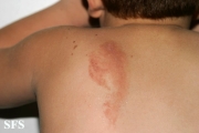 phytophotodermatitis