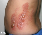 phytophotodermatitis