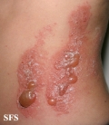 phytophotodermatitis