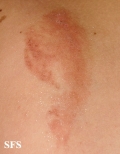 phytophotodermatitis