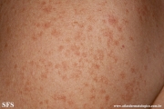 telangiectasia_macularis_eruptiva_perstans