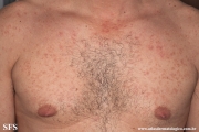 telangiectasia_macularis_eruptiva_perstans