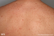 telangiectasia_macularis_eruptiva_perstans