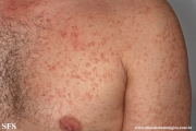 telangiectasia_macularis_eruptiva_perstans