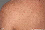 telangiectasia_macularis_eruptiva_perstans