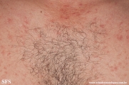 telangiectasia_macularis_eruptiva_perstans