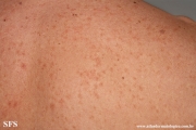 telangiectasia_macularis_eruptiva_perstans