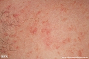 telangiectasia_macularis_eruptiva_perstans