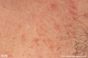 telangiectasia_macularis_eruptiva_perstans