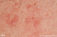 telangiectasia_macularis_eruptiva_perstans