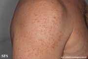telangiectasia_macularis_eruptiva_perstans