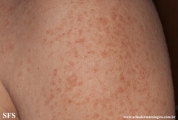 telangiectasia_macularis_eruptiva_perstans