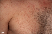 telangiectasia_macularis_eruptiva_perstans