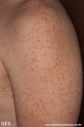 telangiectasia_macularis_eruptiva_perstans