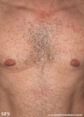 telangiectasia_macularis_eruptiva_perstans