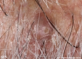 syringocystadenoma papilliferum and hydrocystoma