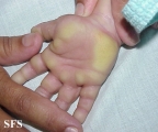 difuse palmoplantar keratoderma