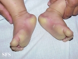 difuse palmoplantar keratoderma