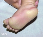 difuse palmoplantar keratoderma
