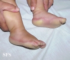 difuse palmoplantar keratoderma