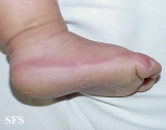 difuse palmoplantar keratoderma