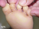 difuse palmoplantar keratoderma