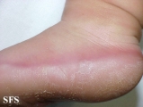 difuse palmoplantar keratoderma
