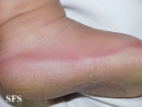 difuse palmoplantar keratoderma