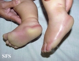 difuse palmoplantar keratoderma