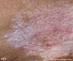 lichen sclerosus et atrophicus