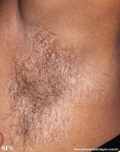 lichen sclerosus et atrophicus