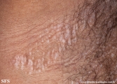 lichen sclerosus et atrophicus
