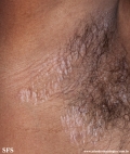 lichen sclerosus et atrophicus