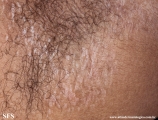 lichen sclerosus et atrophicus