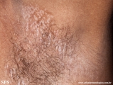 lichen sclerosus et atrophicus